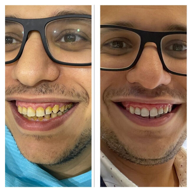 SCALING & ZOOM WHITENING