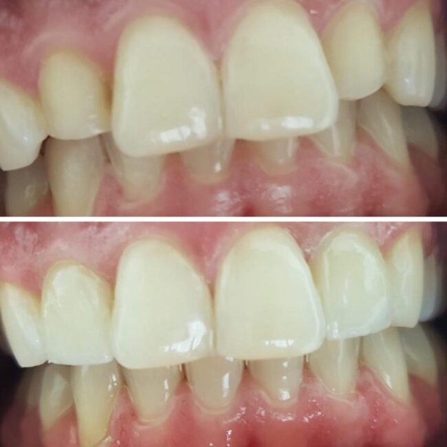 Veneers-specific-size-and-shape-correction