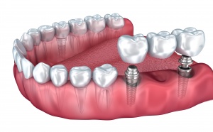 dental-implant