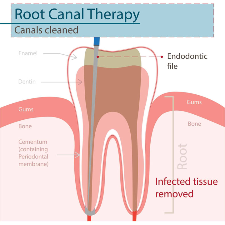 root-canal